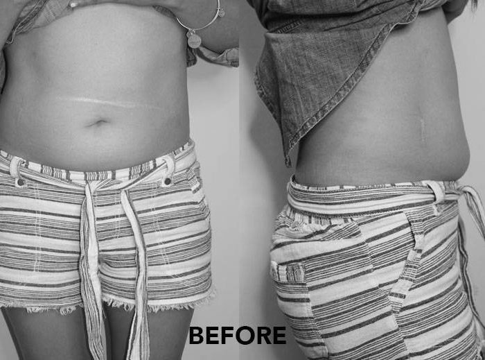 How to Lose Stubborn Body Fat Effectively Through Cryolipolysis